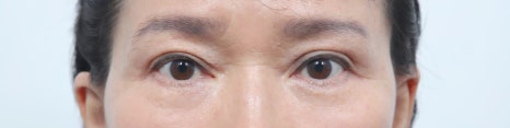 Double Eyelid Surgery in Middle Age: Improving Drooping Eyelids and Differences from Upper Blepharoplasty image 9