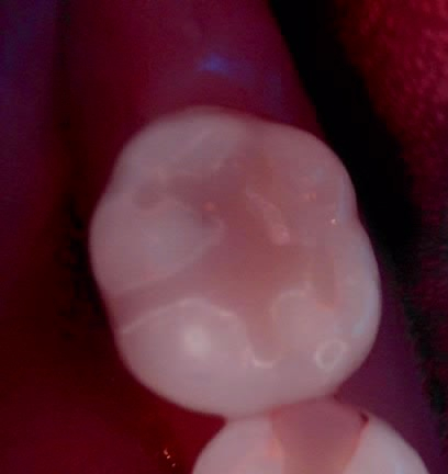 교대역 치과 보철 아래 2차 충치를 다시 레진으로 관련 이미지 20