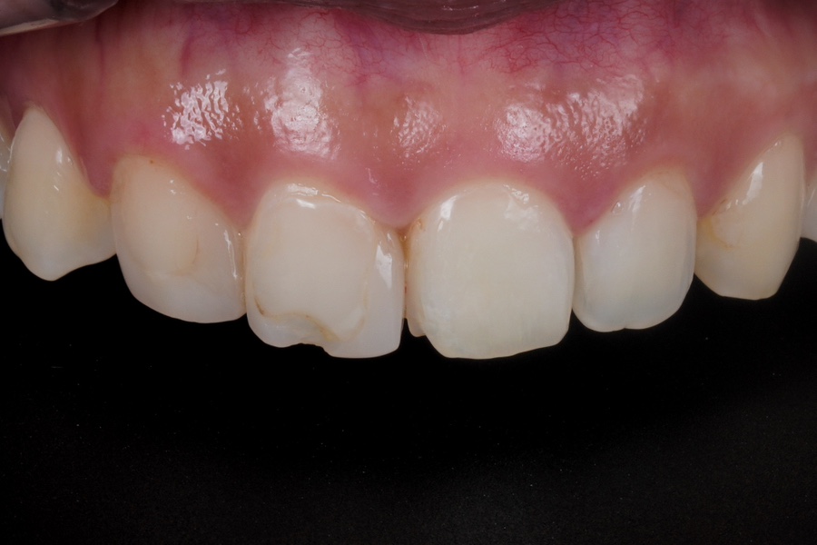 앞니 깨짐 레진 어디서할지 고민될 때 꼭 보세요 관련 이미지 9