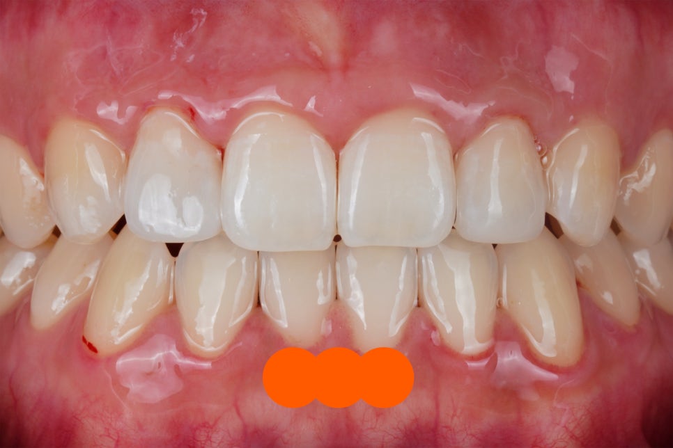 왜소치 라미네이트 대신 완전 무삭제로 1시간만에 치료 하세요 관련 이미지 2