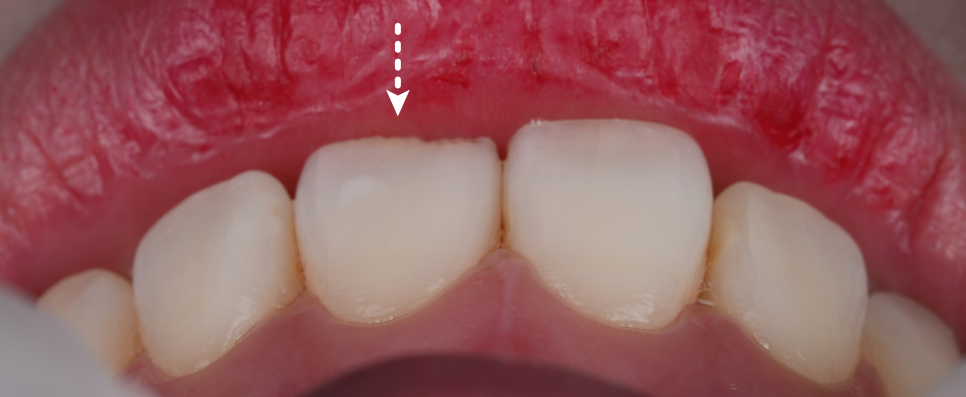 강남치과 짧아 보이는 치아 레진으로 당일 치료 관련 이미지 4