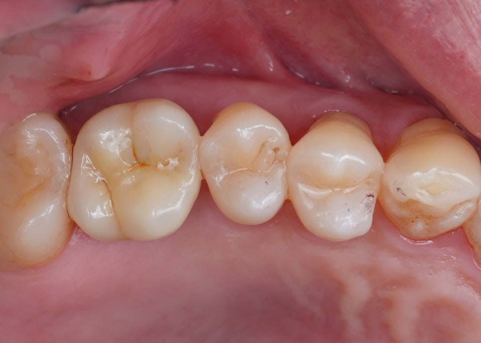 임플란트 구멍, 레진 빌드업으로 메우기 관련 이미지 1