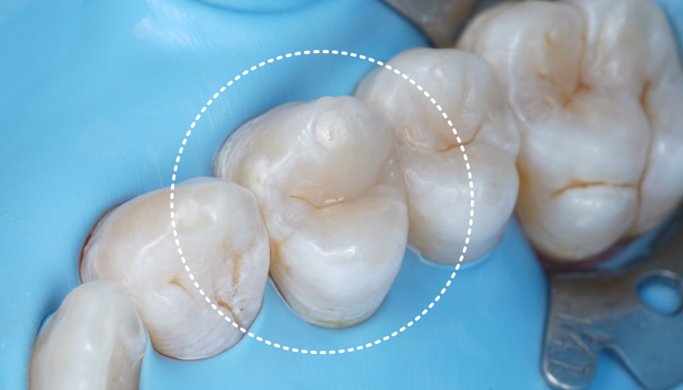 강남역치과 치료 부위 2차 충치 레진 재치료 사례 관련 이미지 11