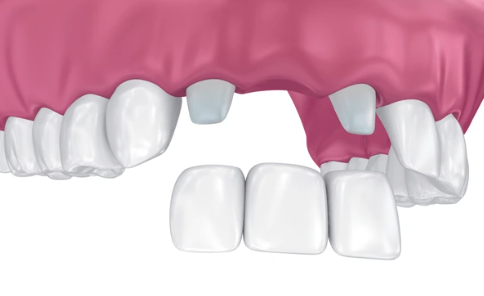 앞니 크라운 브릿지 재치료 시 이럴 땐 따로 제작해야 돼요 관련 이미지 8