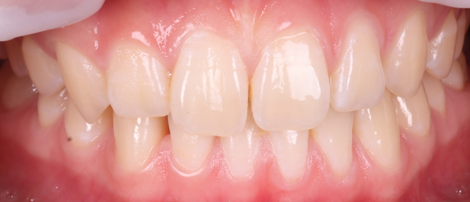역삼역치과 벌어진 앞니 레진 이렇게 해야 진짜 티 안나요 관련 이미지 5