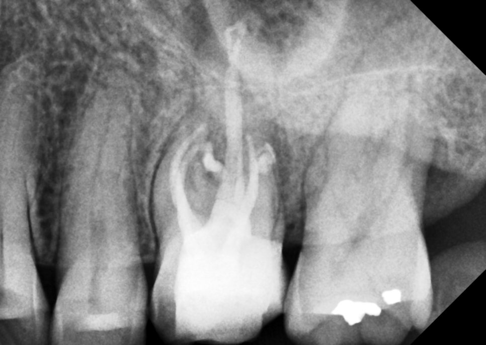 부모님(아버지) 어금니 재신경치료 해드린 썰 푼다.txt 관련 이미지 4