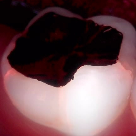 교대역 어금니 크랙 깨짐으로 씹을때 통증, 발치 피하고 신경치료로 유지한 케이스 관련 이미지 1