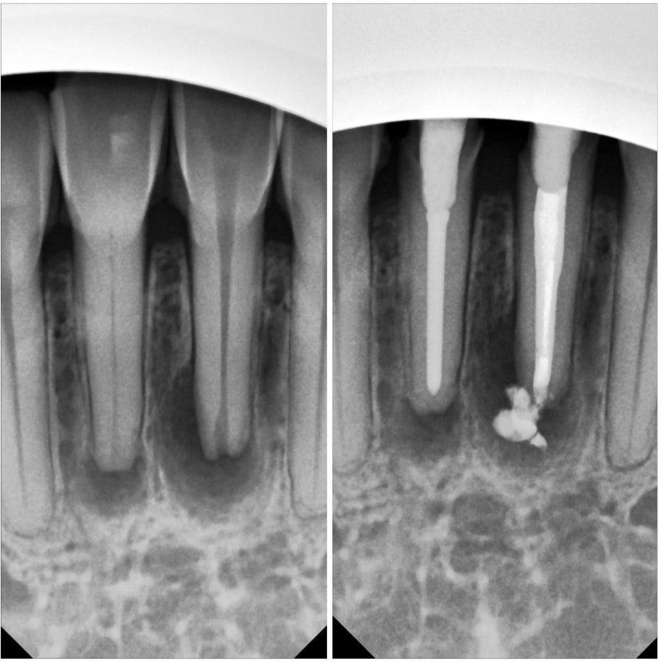 교대역 앞니 신경치료 후 지르코니아 크라운 치과 관련 이미지 3