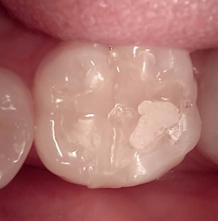 치과보존과 치아를 덜 깎는 치료를 지향하는 이유 관련 이미지 8