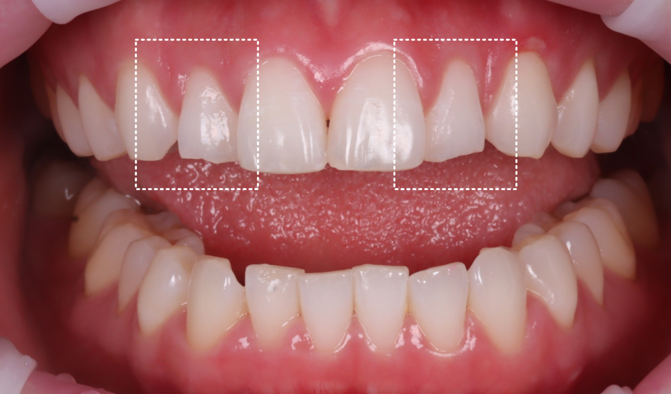 If Your Front Teeth Look Extra Large, Be Sure to Read This — Gyodae Station Dental Clinic image 1