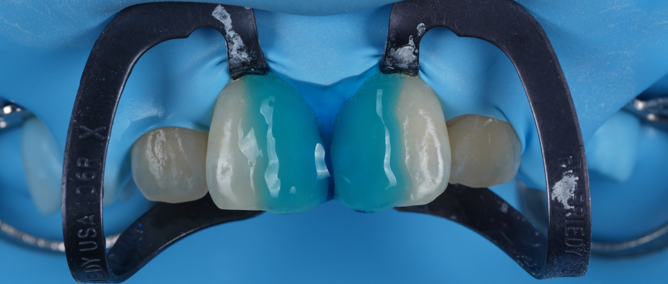 양재역치과 앞니 레진 받으러 수원에서 오신 이유(feat. 치과의사 소개) 관련 이미지 7