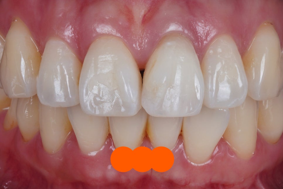 앞니 신경치료 변색 원인과 치료법인 실활치 미백 관련 이미지 13