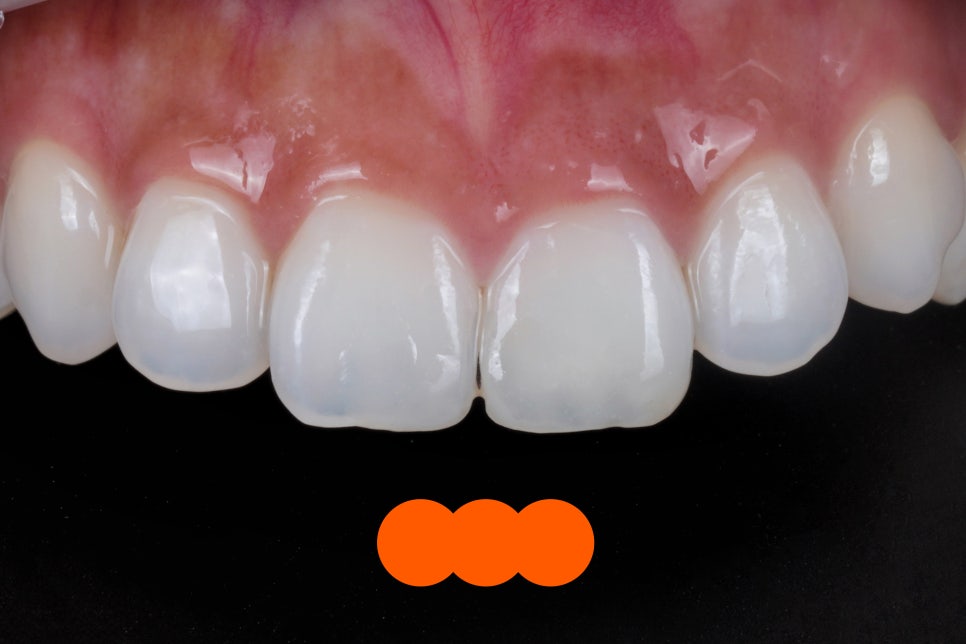 앞니 신경치료 변색 원인과 치료법인 실활치 미백 관련 이미지 9