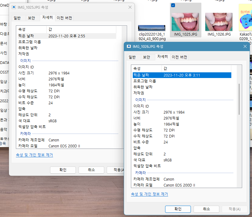 앞니 깨짐, 레진 빌드업으로 금방 다시 만들어 주기 관련 이미지 3