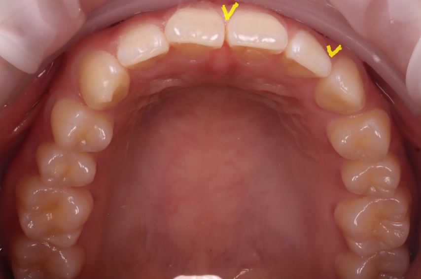 역삼역치과 벌어진 앞니 레진 이렇게 해야 진짜 티 안나요 관련 이미지 16
