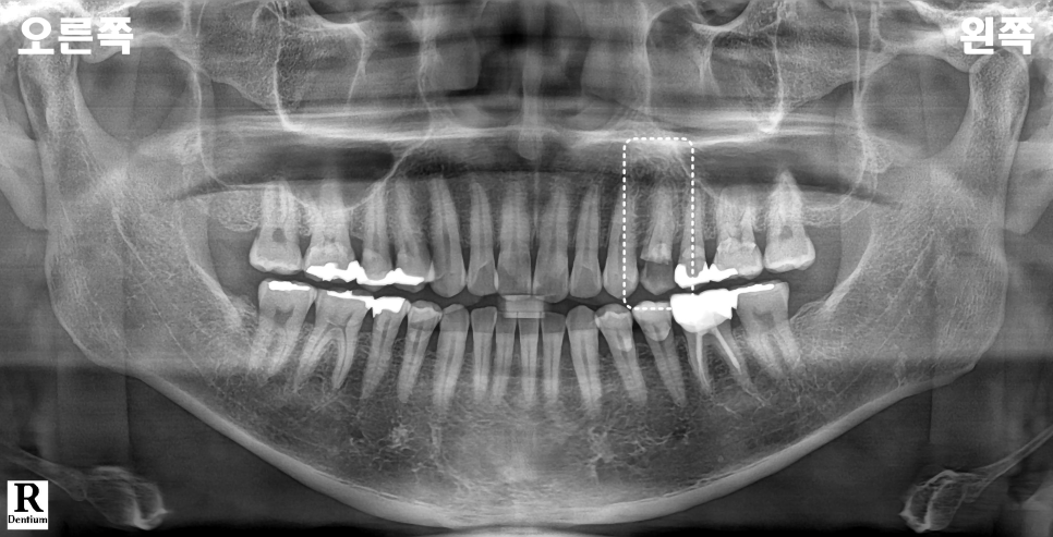교대치과 신경치료 후 크라운 안 하고 오버레이로 보존 관련 이미지 6
