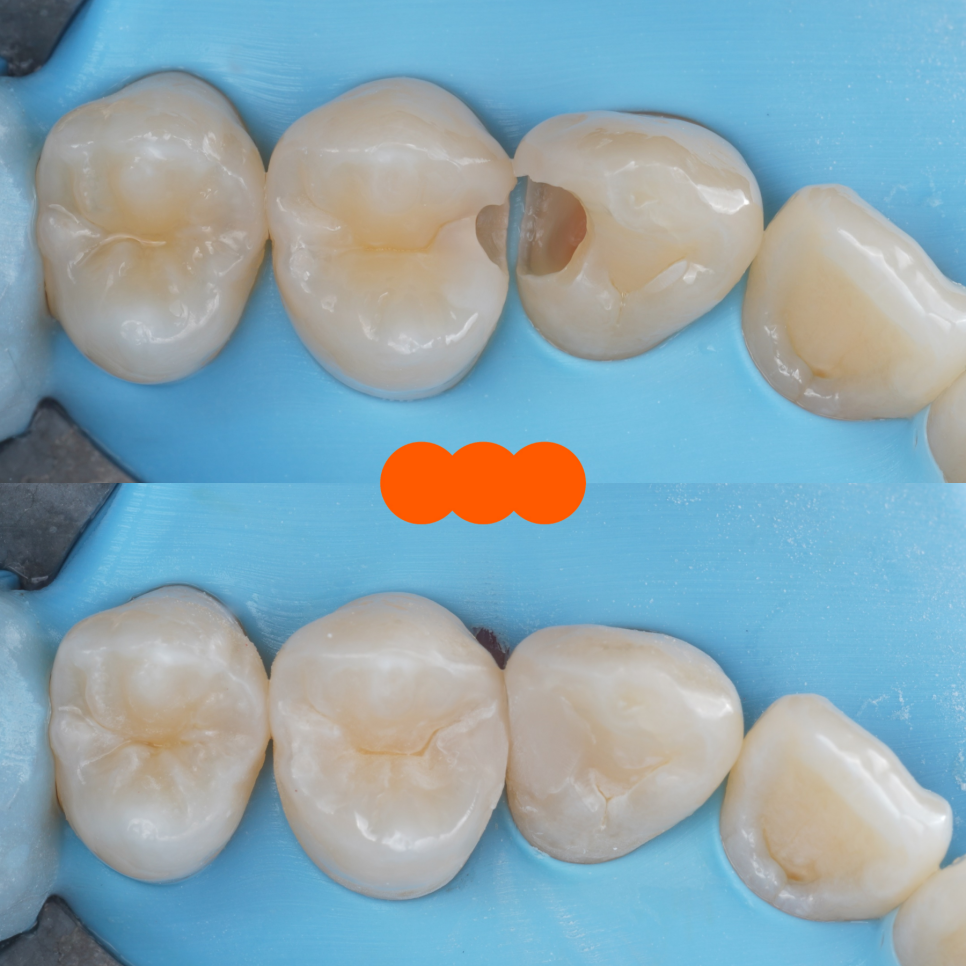 역삼역 치과 치대생 깊은 충치 신경치료없이 레진으로 완료 관련 이미지 16