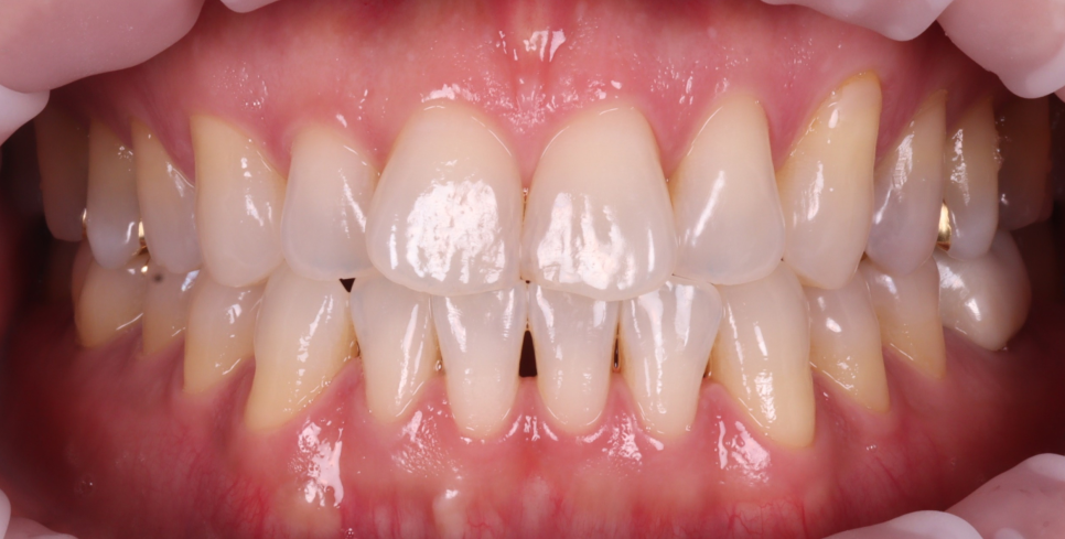 교대치과 신경치료 후 크라운 안 하고 오버레이로 보존 관련 이미지 3