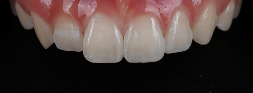 역삼역치과 벌어진 앞니 레진 이렇게 해야 진짜 티 안나요 관련 이미지 18