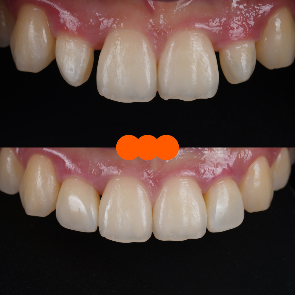 왜소치 라미네이트보다 레진 비니어를 더 추천드리는 이유 관련 이미지 12