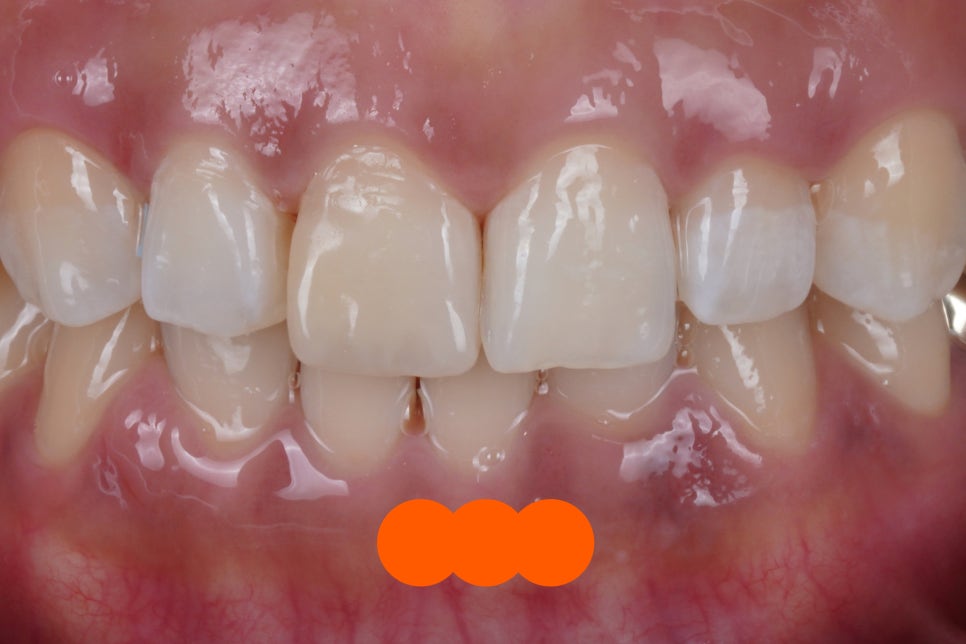 앞니 레진이 깨졌을 때, 재치료 잘하는 서초 치과 관련 이미지 2