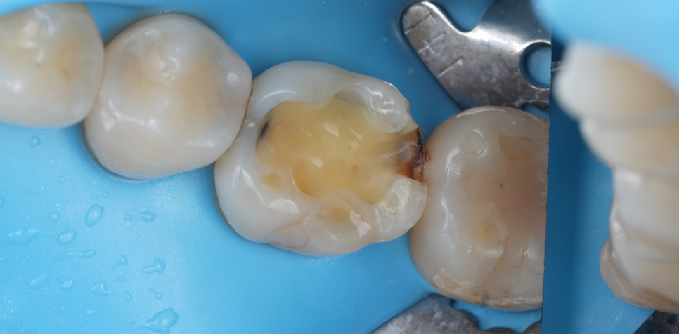 교대역 치과 보철 아래 2차 충치를 다시 레진으로 관련 이미지 25
