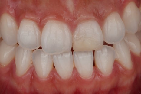 앞니 신경치료 변색 원인과 치료법인 실활치 미백 관련 이미지 7