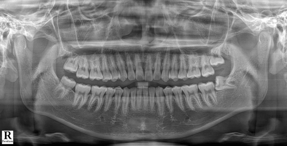 교대역 누운 매복 사랑니 당일 발치, 강남대성 별관에서 온 학생 관련 이미지 1