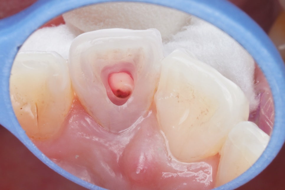 실활치 미백 과정, 크라운 없이 레진으로 마무리 해요 관련 이미지 2