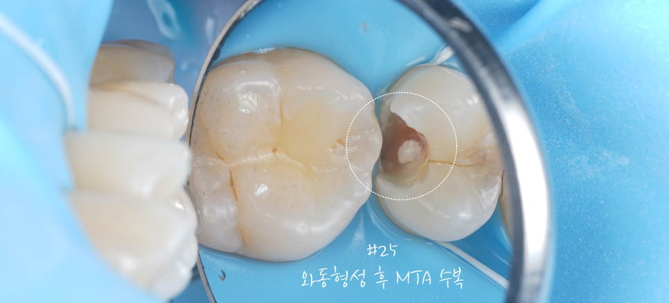 서초역치과 이걸로 신경치료 미뤄드리고 있어요 관련 이미지 9