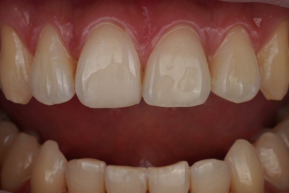 치과의사의 치아 살짝 깨짐, 레진으로 치료한 서초동 치과 관련 이미지 3