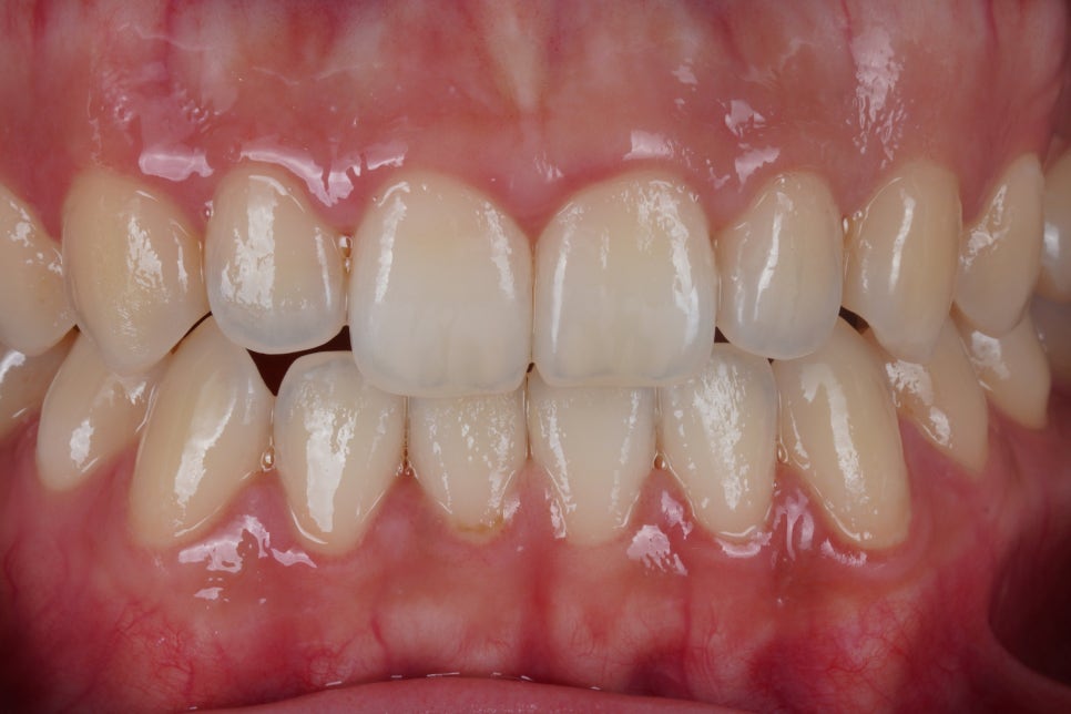 왜소치 라미네이트 대신 완전 무삭제로 1시간만에 치료 하세요 관련 이미지 1