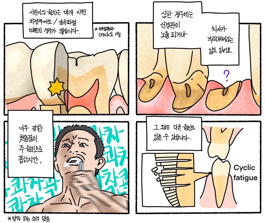 자꾸만 시린 치아, 치경부 마모증 레진 수복 이야기 관련 이미지 1