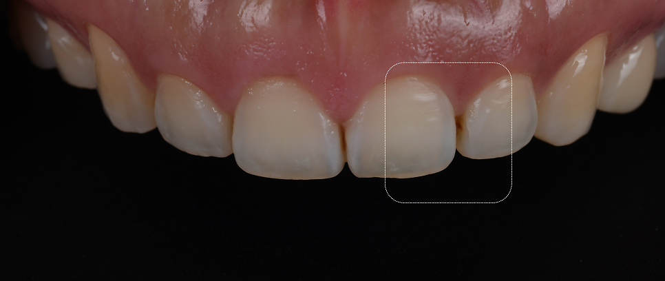 서초구치과 치아 사이 삭제 부작용과 치료법 관련 이미지 4