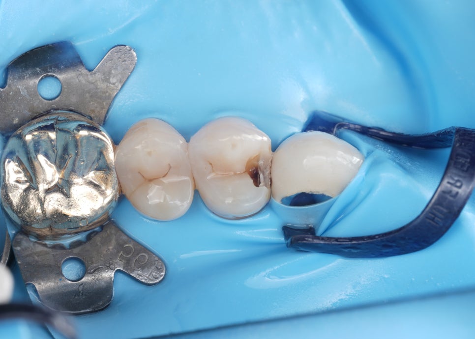 치아 사이 충치를 치료하는 방법, 레진과 인레이 비교 관련 이미지 2