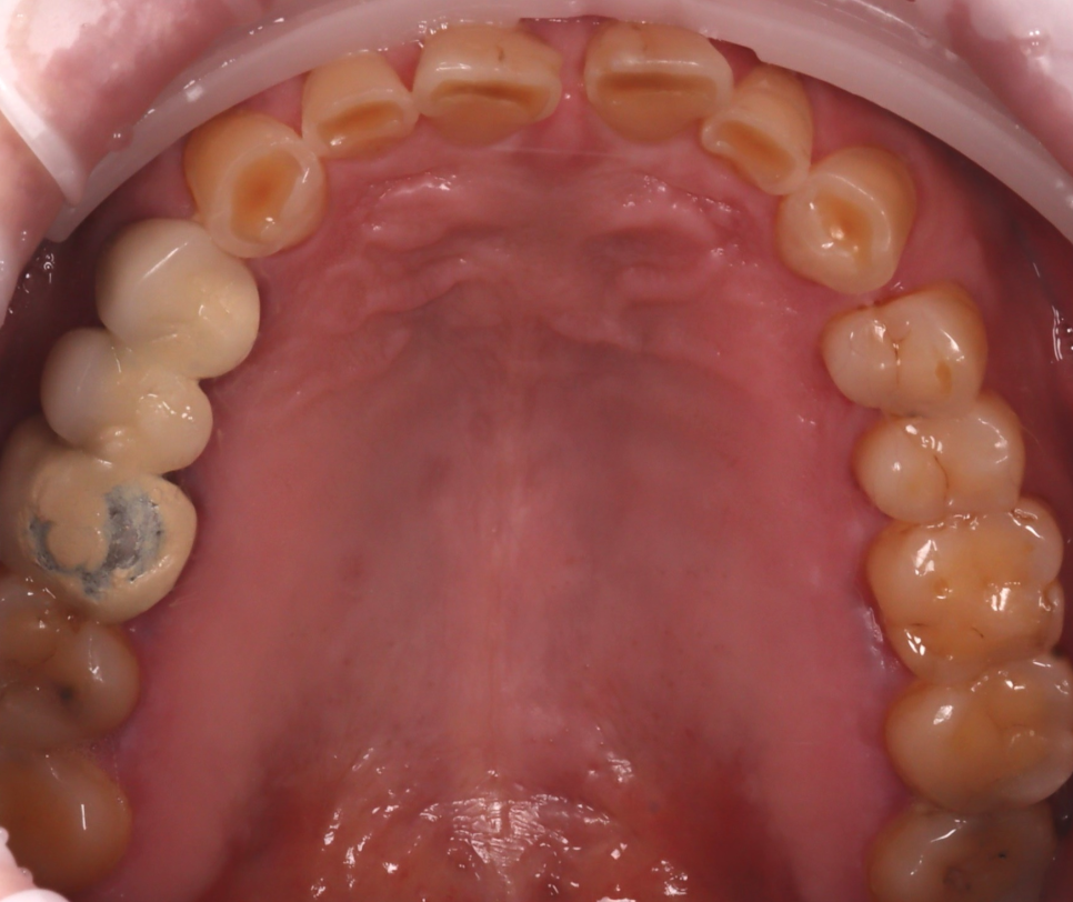 신논현역치과 심하게 마모된 60대 남성 앞니 크라운 치료 관련 이미지 4