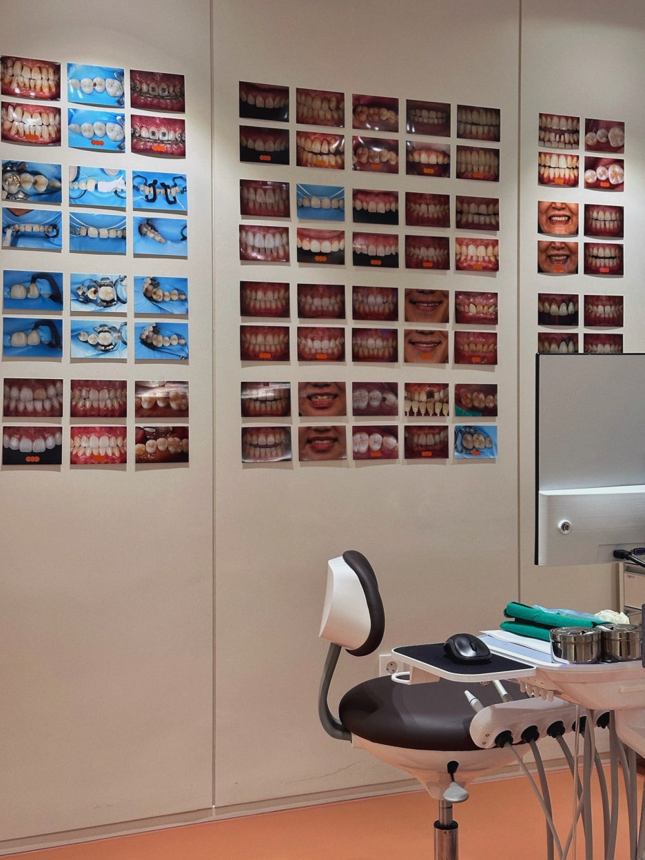 강남치과추천 앞니 하얀 반점 당일 심미 레진으로 해결 관련 이미지 3