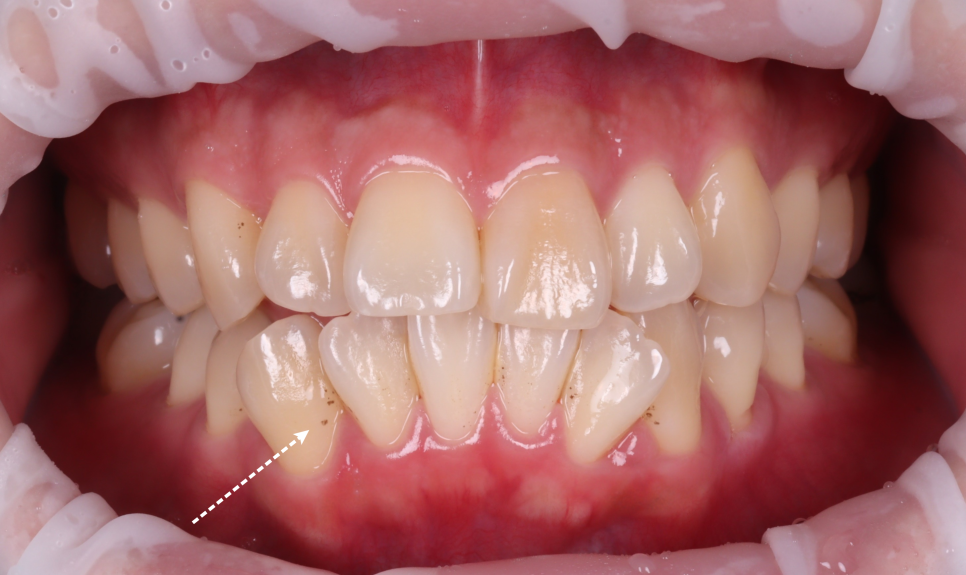 서초동치과 착색 고민되면 에어플로우 하세요 관련 이미지 2