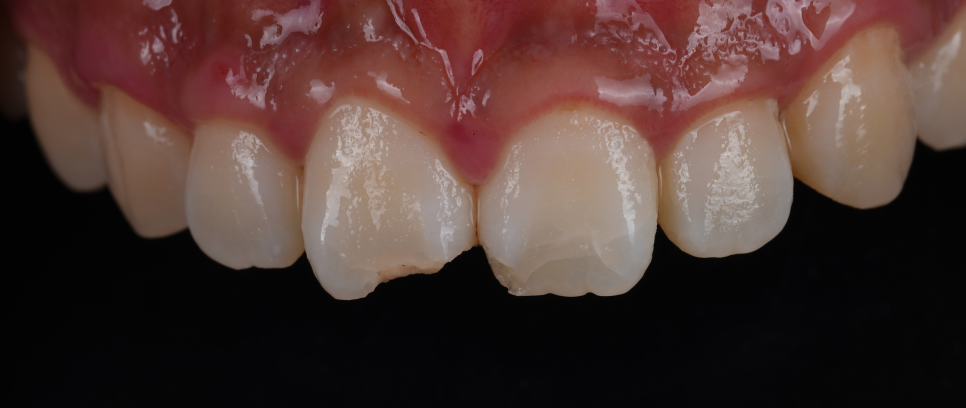 반포동치과 앞니 깨짐 레진 삭제 없이 당일에 치료 끝 관련 이미지 6