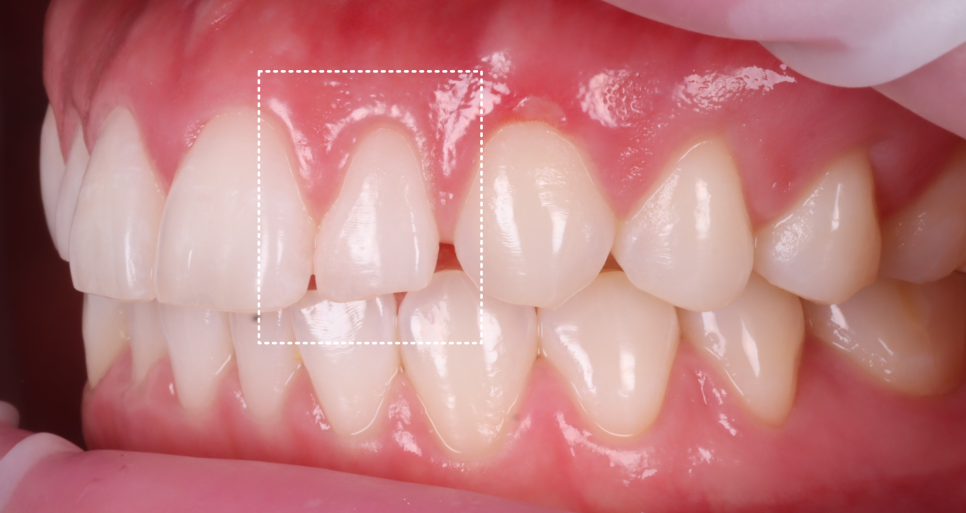 If Your Front Teeth Look Extra Large, Be Sure to Read This — Gyodae Station Dental Clinic image 4