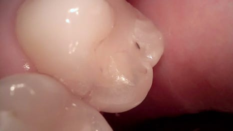 교대역 치과 보철 아래 2차 충치를 다시 레진으로 관련 이미지 7