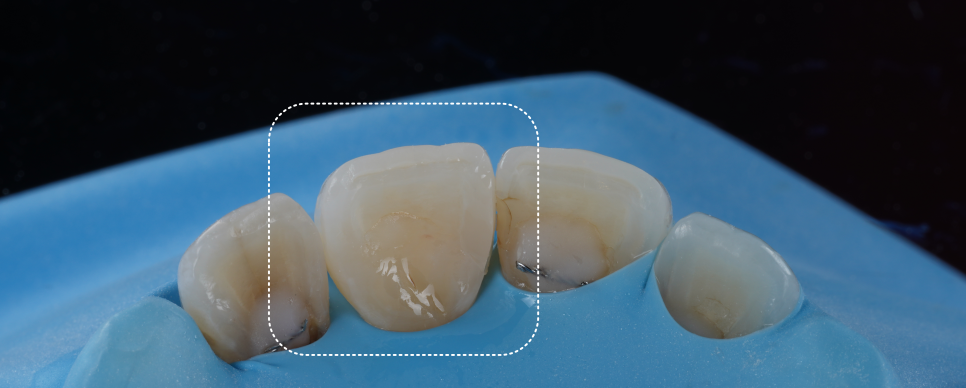 고속터미널역치과 레진치료 처음부터 잘 받아야 하는 이유 관련 이미지 10