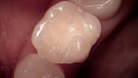 교대역 치과 보철 아래 2차 충치를 다시 레진으로 관련 이미지 13