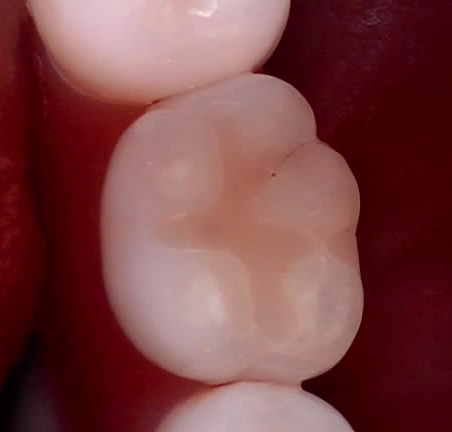 교대역 치과 보철 아래 2차 충치를 다시 레진으로 관련 이미지 18