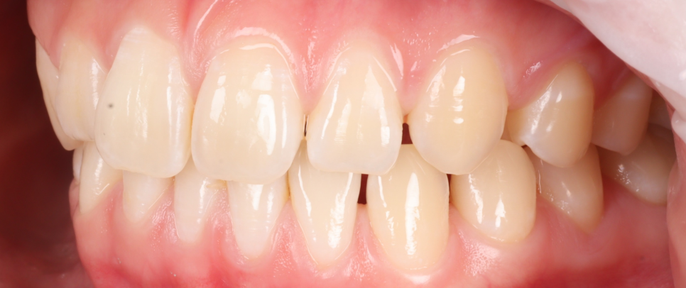 역삼역치과 벌어진 앞니 레진 이렇게 해야 진짜 티 안나요 관련 이미지 6