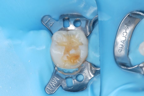 Jamnwon-dong Dental Clinic: Don’t Grind Down Your Teeth—Get Resin Build-up Instead image 7