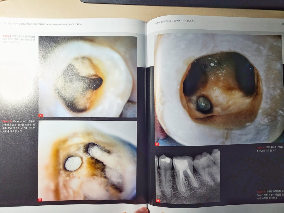 <책> 재근관치료 - 치수기원 치근단 병소의 치료 관련 이미지 3