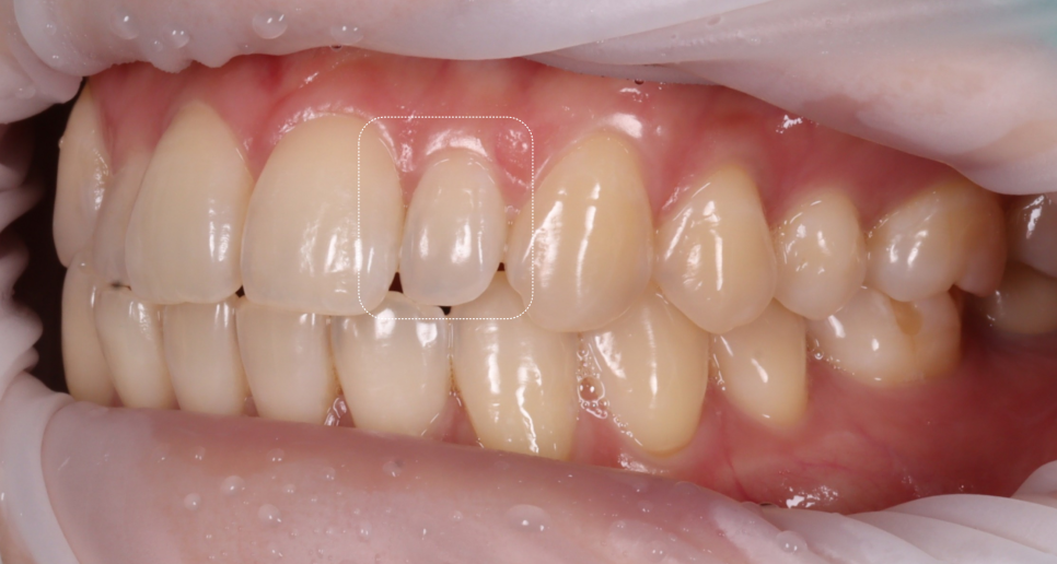 왜소치레진 20년 전에 했던 치아 재치료 후 반대쪽까지 관련 이미지 5