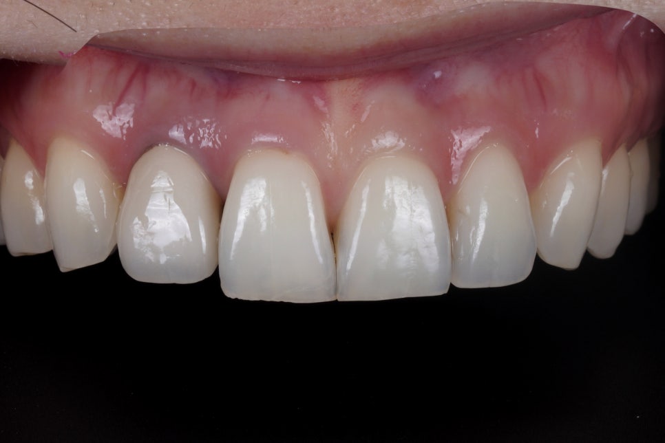 앞니 레진 라미네이트, 1시간 원데이 치료가 가능한 교대 치과 관련 이미지 8