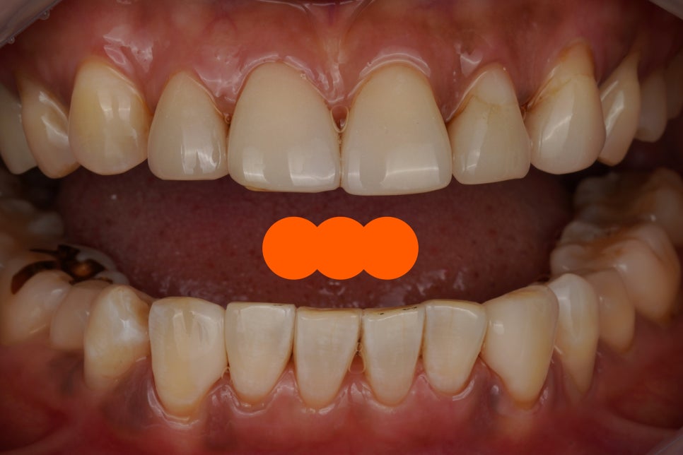 20년 전 때운 레진 떨어짐으로 이 사이 벌어짐 치료 : 교대역 치과에서 당일 레진 관련 이미지 5